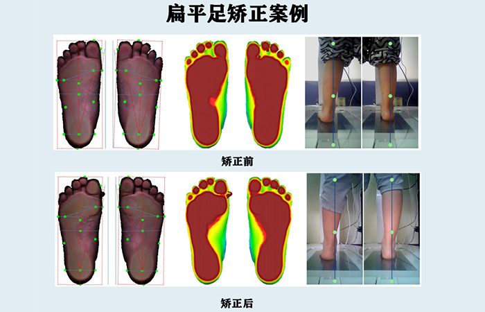 青少年足部矫正解决方案