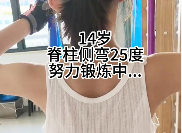 14岁女孩脊柱侧弯训练中