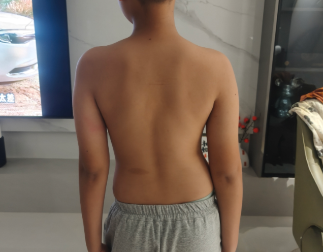 脊柱侧弯支具第一次穿戴，为什么要再次拍片？不止看矫正效果