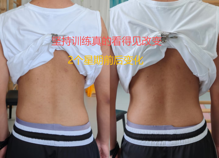 孩子有脊柱侧弯,坚持训练真的看得见改变